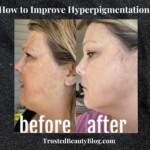 How to Improve Hyperpigmentation