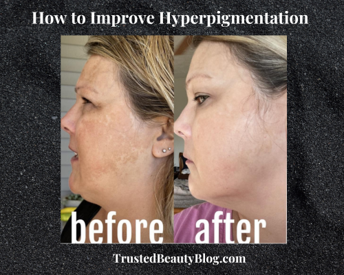 How to Improve Hyperpigmentation